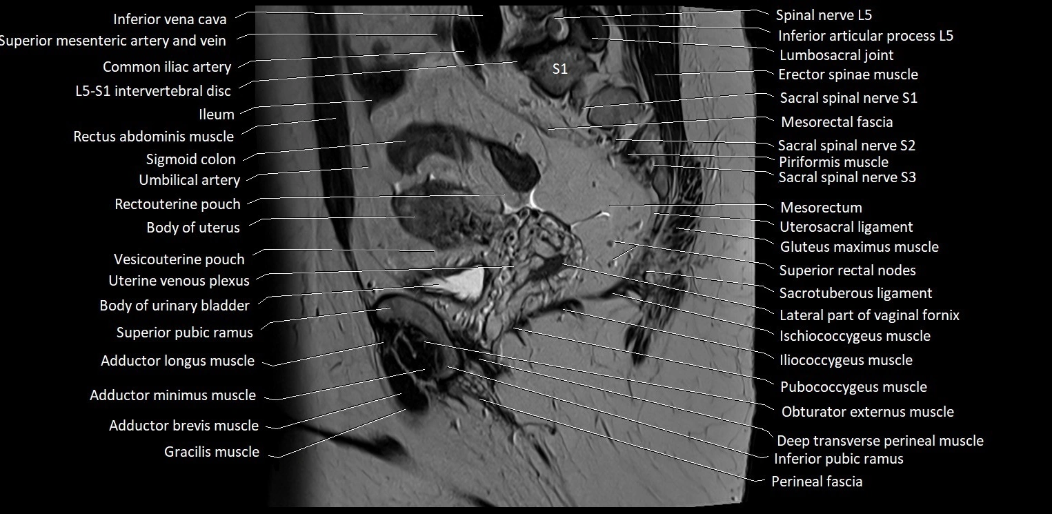 Sagittal cross sectional anatomy of female pelvis (MRI 3T) image 15.webp